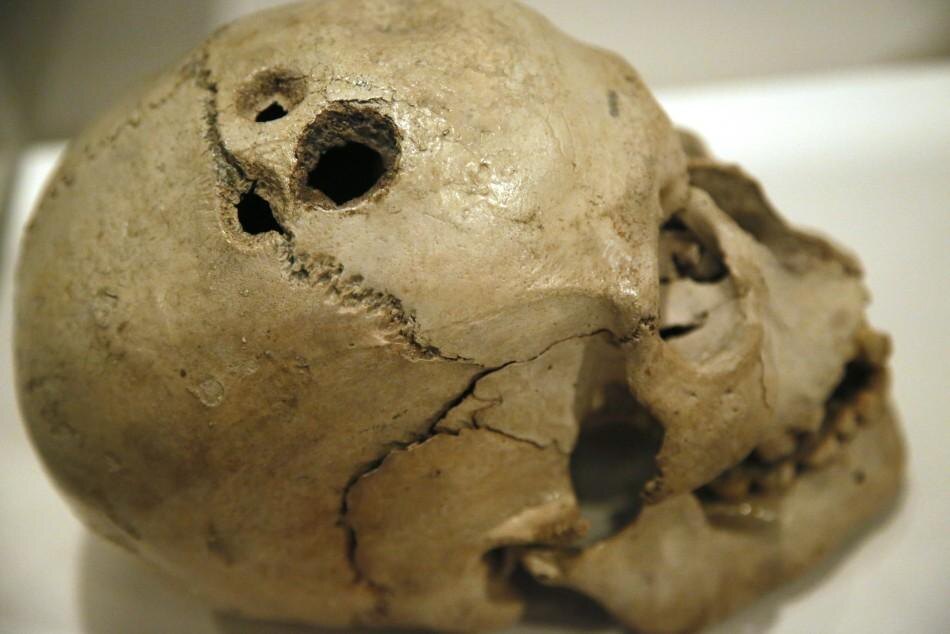 The skull found in Peru with traces of trepanation                                                                                      https://s1.ibtimes.com/sites/www.ibtimes.com/files/styles/embed/public/2012/03/28/254381-a-human-skull.jpg