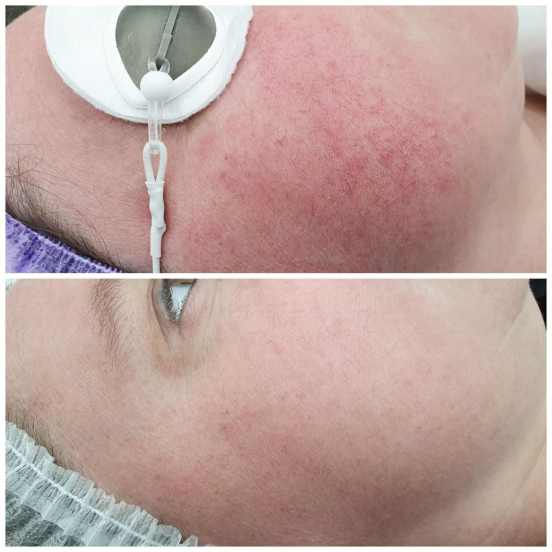 Результат до/после фотолечения розацеа в клинике "Modifique". Работа Орловской Александры Владимировны.