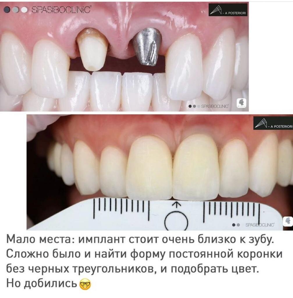 Десна отходит от зуба с картинками