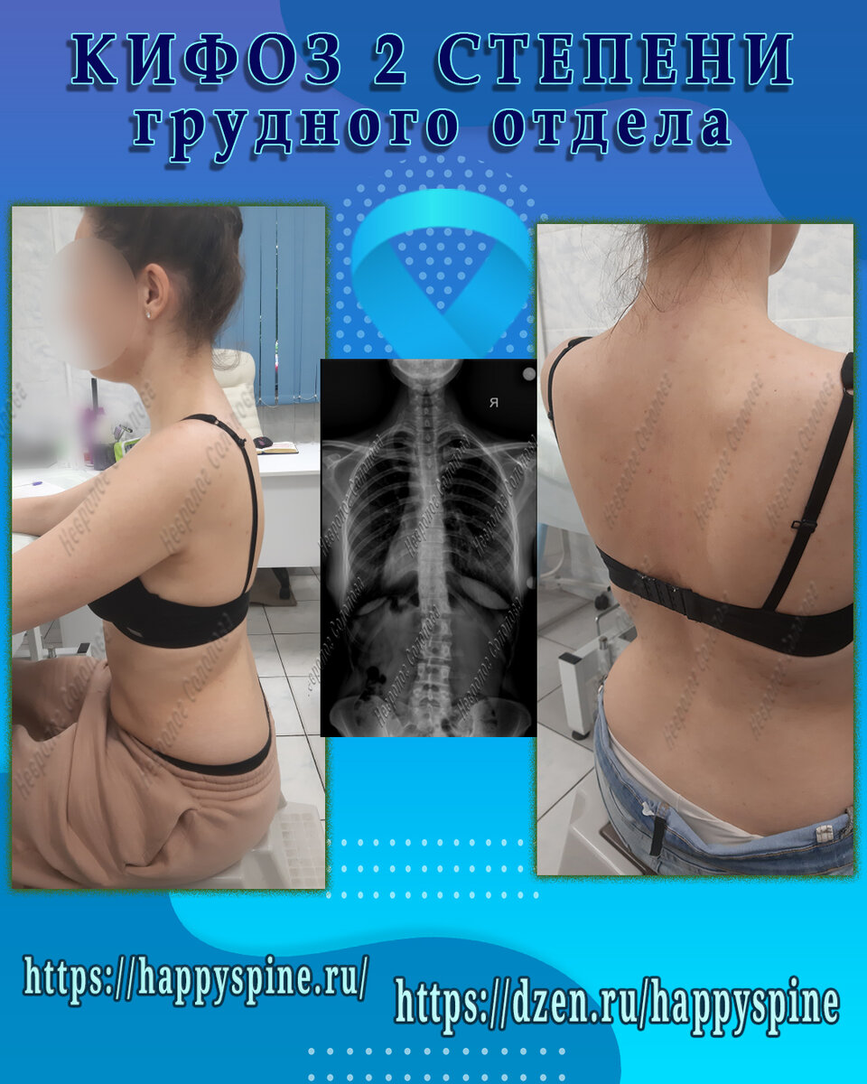 Грудной гиперкифоз что это. Кифоз грудного отдела позвоночника кифоз. Гиперкифоз грудного отдела позвоночника у детей. Грудной гиперкифоз что это. Гиперкифоз грудного отдела позвоночника.