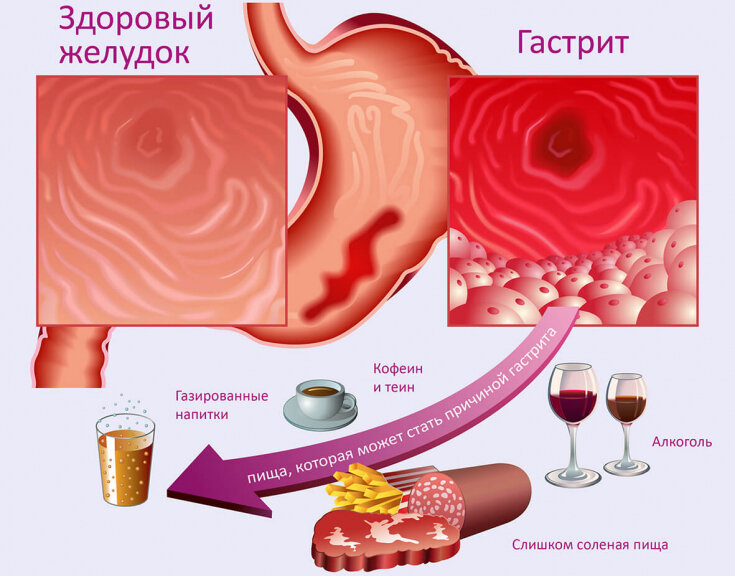 Гастрит: причины, симптомы, лечение (диета, питание)