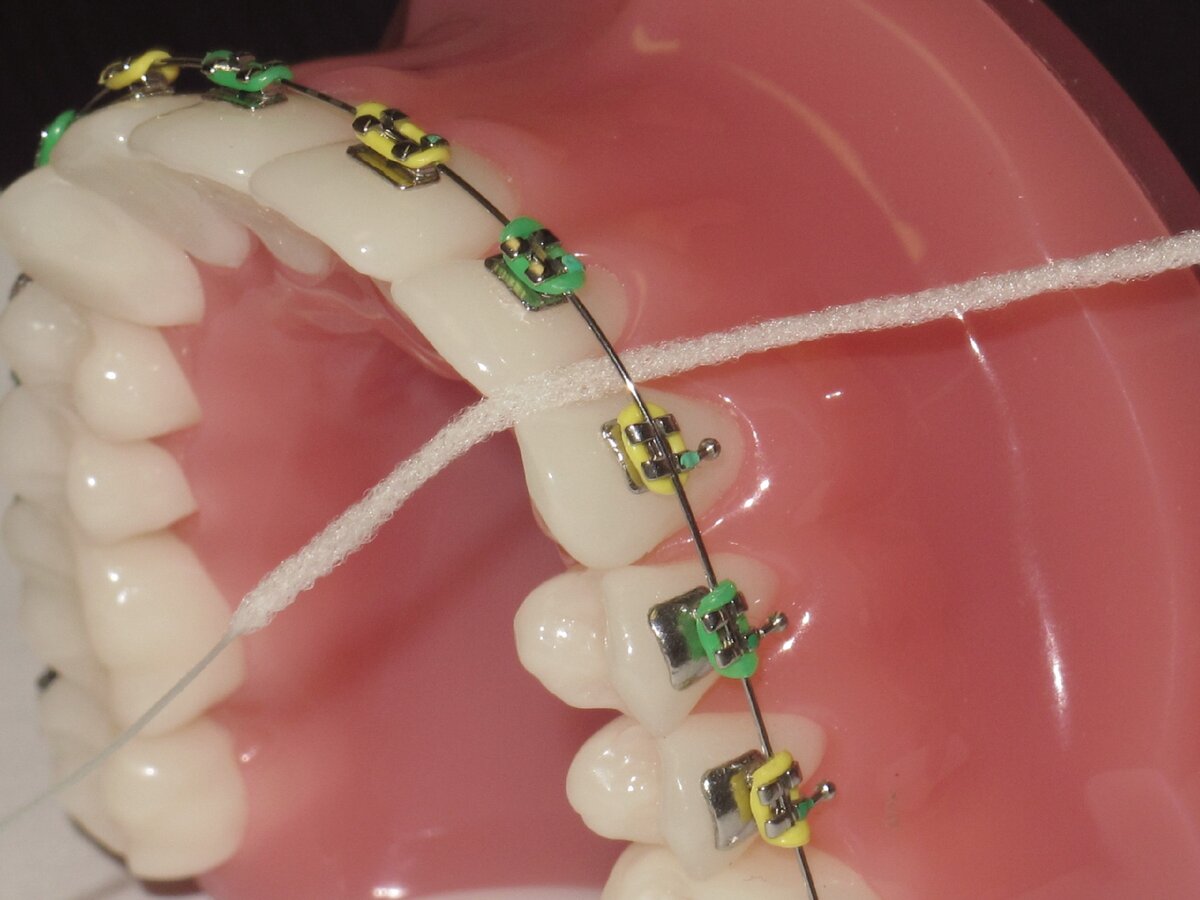 Ретейнеры можно делать мрт. Флосс и суперфлосс. Зубная нить суперфлосс. Ортодонтический суперфлосс.