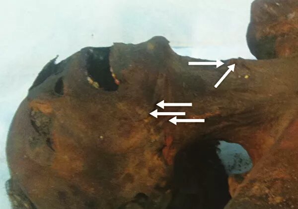 В 1115 году до нашей эры в гареме Рамзеса III разыгралась драма. Одна из его неглавных жен Тия вместе с сыном Пентауром устроили переворот, в результате которого фараон был убит. Однако захватить власть им не удалось: верные слуги правителя разоблачили заговор и устроили суд над его участниками. Этот процесс описан в Туринском судебном папирусе, но многие детали оставались неясны.Ученые не были уверены, точно ли покушение на Рамзеса III закончилось его гибелью или он был только ранен. Его мумию вместе с другими нашли в XIX веке в некрополе Дейр-эль-Бахри в окрестностях Луксора. Там же была ужасная мумия с застывшим выражением крика на лице. Ее назвали "безымянный царевич Е" и предположили, что это и есть Пентаур. Суд приговорил его к публичному самоубийству, но каким способом, неизвестно. Высказывали гипотезы о яде и погребении живьем.В 2012 году большой коллектив ученых из Египта, Италии и Германии изучил обе мумии. Провели антропологические, криминалистические экспертизы, ДНК-тесты и компьютерную томографию.Сканирование мумии Рамзеса показало большую рану прямо под гортанью. Мягкие ткани, трахея и все органы в этой области были разорваны. Это определенно стало причиной немедленной смерти.© Фото : Theban Royal Mummy ProjectМумия фараона Рамзеса IIIПосле более детальной компьютерной томографии обнаружили раны на ступнях. Судя по всему, царя атаковали спереди копьем или мечом, а сзади ему перерезали горло кинжалом."Безымянному царевичу Е" было 18-20 лет. Мумифицировали его не как всех. Внутренние органы и мозг не изъяли, натерли смесью смолы и извести, отчего кожа приобрела красноватый оттенок. Других обертывали в белые одежды, тщательно бальзамировали, а этого завернули в козью кожу, считавшуюся нечистой. Кожа под правой нижней челюстью и левой частью шеи покрыта складками и морщинами, легкие вздуты. Это — вероятные признаки удушения, хотя есть и другие объяснения, например посмертное разложение.Сравнение ДНК позволило сделать однозначный вывод: это отец и сын. Значит, "безымянный царевич Е" — Пентаур. Кстати, это псевдоним, данный судьями. Настоящее имя отцеубийцы неизвестно.© Фото : Cairo UniversityПодозрительные складки в области шеи мумии "безымянного царевича Е" — Пентаура