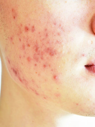 Как избавиться от прыщей за один день?