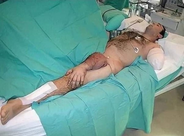 Мужчина после операции