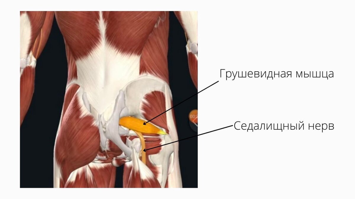 Чрезмерное напряжение грушевидной мышцы приводит к сдавливание седалищного нерва