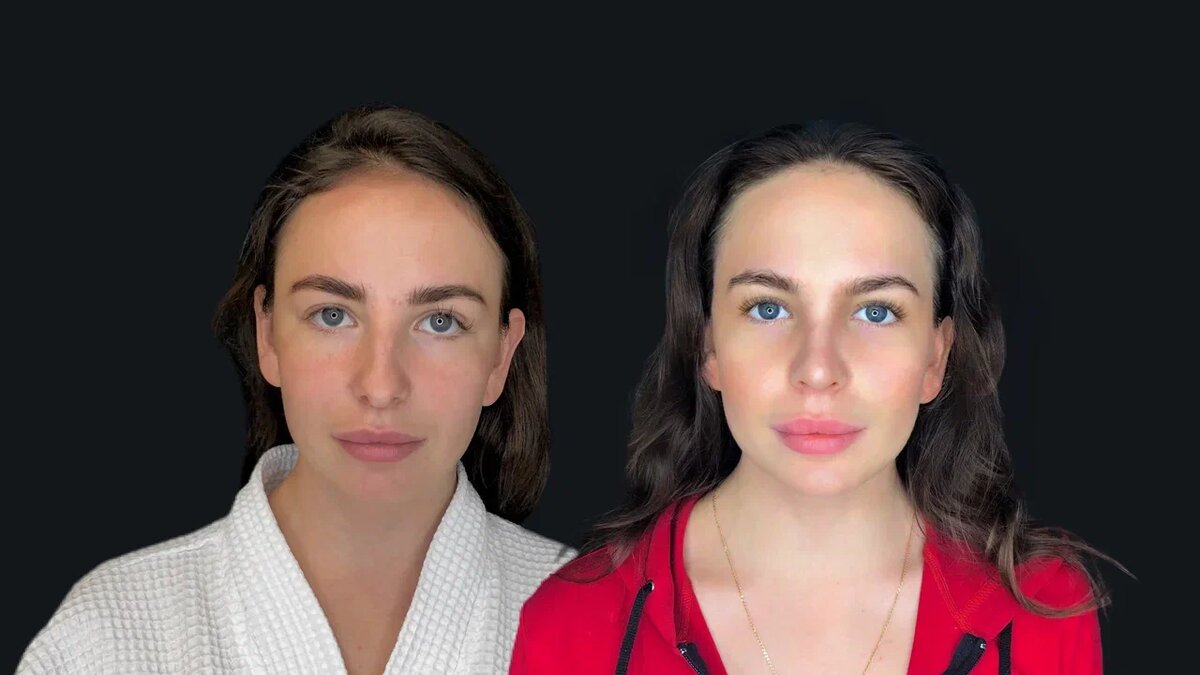 Вторичная ринопластика. Пациентка до и после операции.