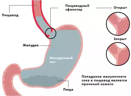 Изжога при беременности ⛑ симптомы при изжоге | natali-fashion.ru
