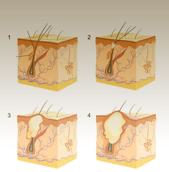 Процесс образования акне