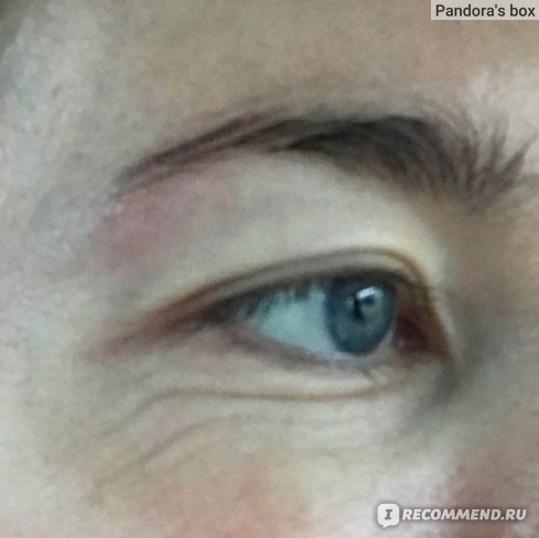 Инъекции Ботокса фото ДО