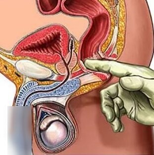Рецепты чаев и настоев для простатита