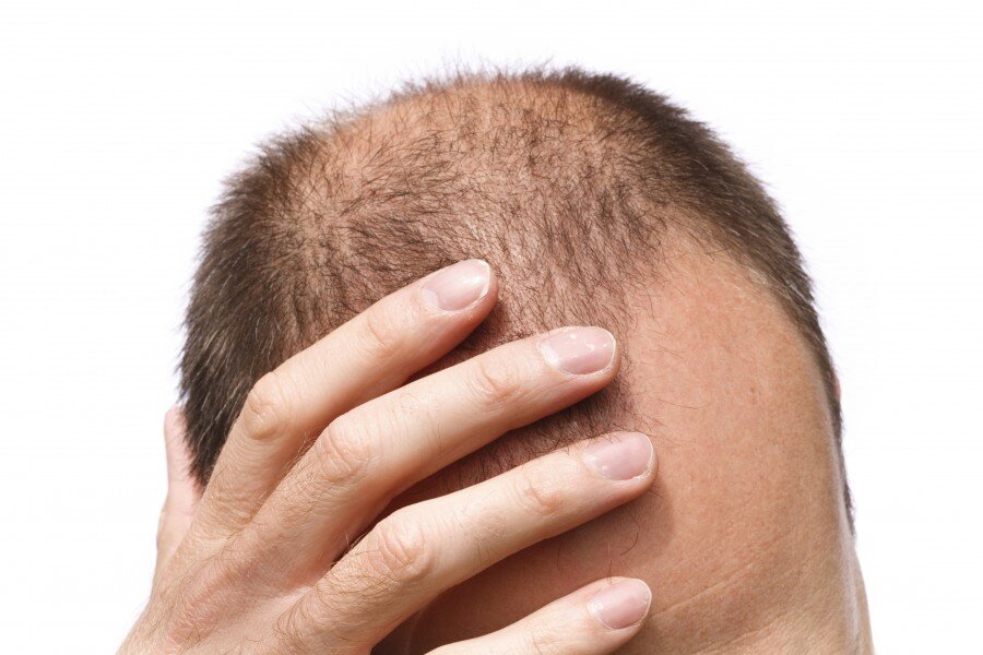 Как остановить выпадение волос: эффективные способы сохранить красоту волос