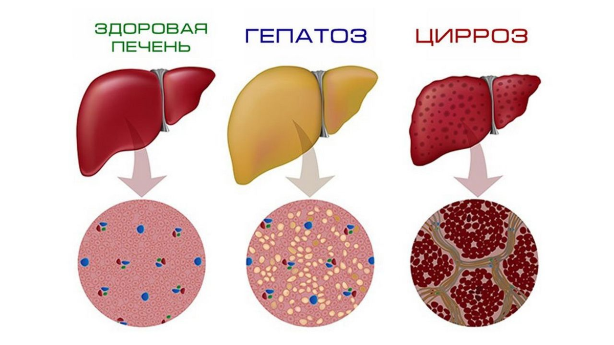 Какая печень лучше. Жировой гепатоз и цирроз печени. Жировой гепатоз (стеатоз) печени. Жировая дистрофия печени(жировой гепатоз). Жировая дистрофия печени гепатоз симптомы