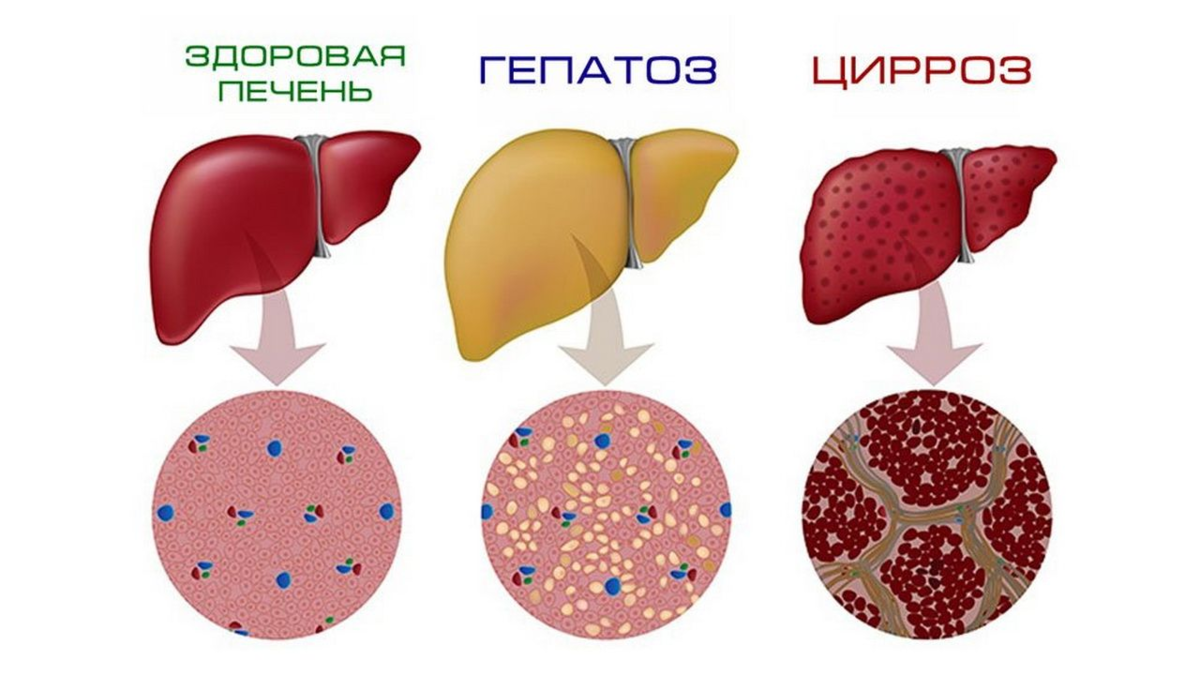 Желчный ожирение. Жировая дистрофия печени(жировой гепатоз). Жировой гепатоз и цирроз печени. Жировое Перерождение печени (жировой гепатоз).