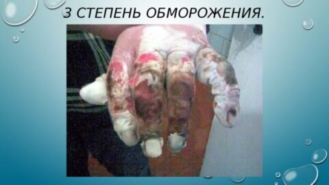  Холодовая травма 3-ей степени – довольно серьезное поражение мягких тканей, которое чревато рядом последствий.