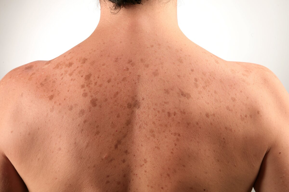 На фото: Отрубевидный лишай у человека (разноцветный, пляжный) 