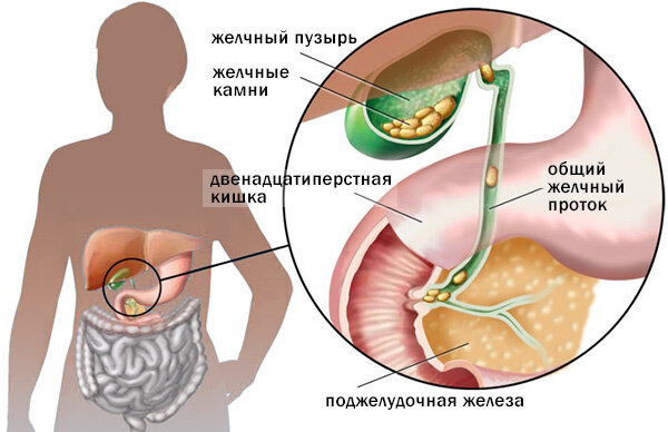 Лечение калькулезного холецистита народными средствами