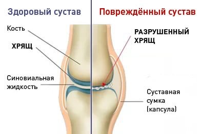 Сравнение здорового и не здорового сустава
Источник: Яндекс.картинки