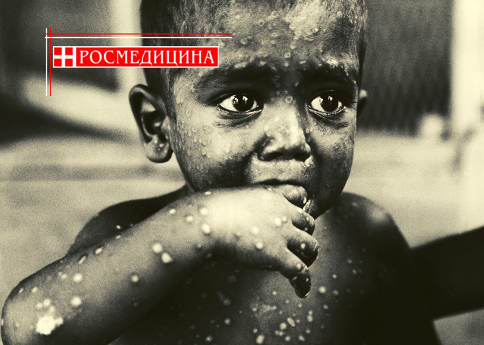 Оспы в природе больше не существует. Образцы вируса хранятся только в США и России. 