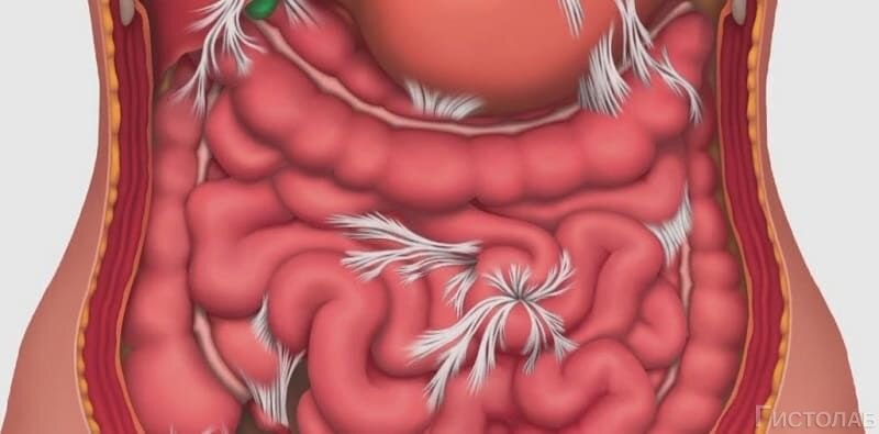 Пневматоз толстой кишки. Спаечная болезнь после аппендицита. Что такое перфорация кишечника