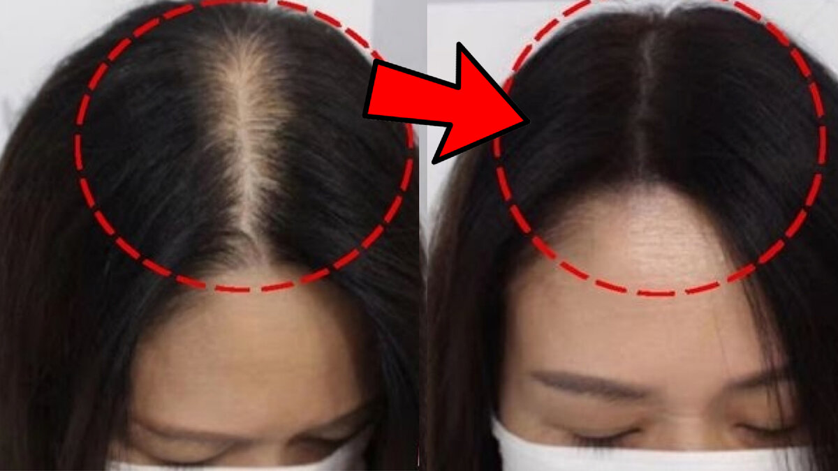 #лечениеволос #выпадениеволос #облысение #какотраститьволосы #уходзаволосами #уходзаволосами #дляроставолос 