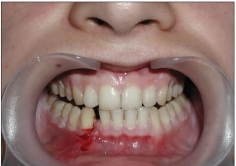   Лечение перелома челюсти дома должно проводиться после всех необходимых  мероприятий в больнице и по четким рекомендациям лечащего врача.