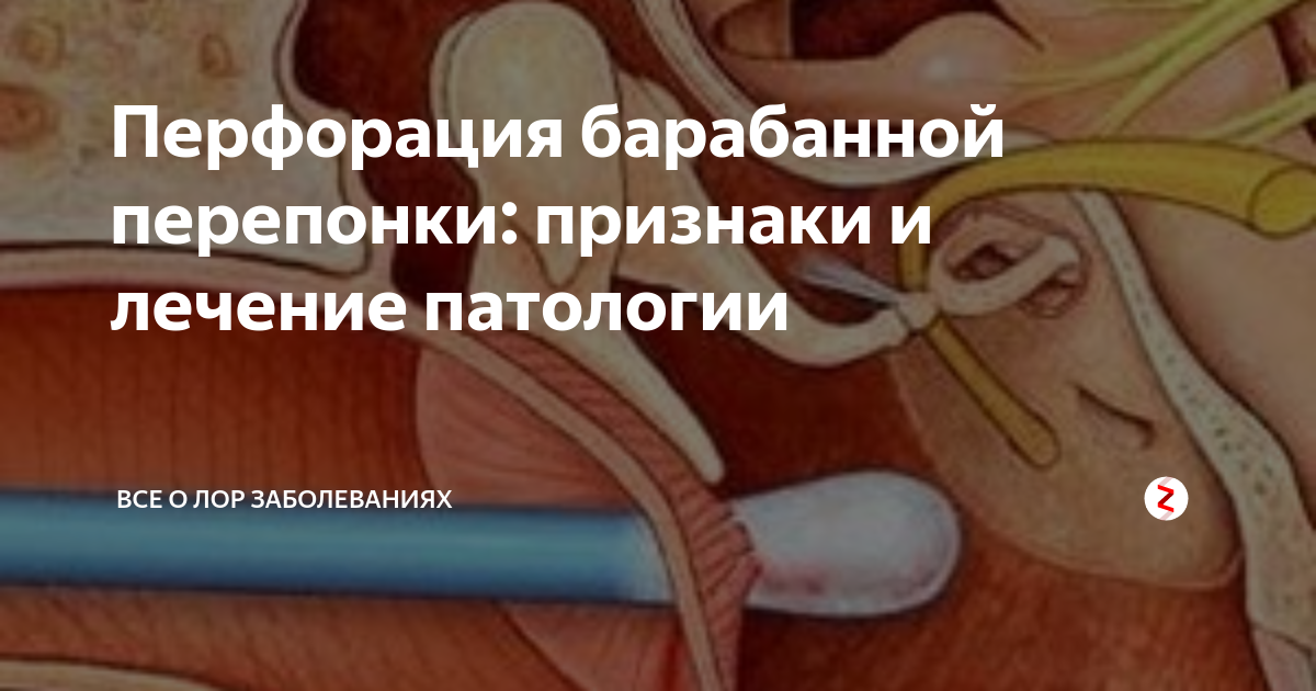 Перфорация барабанной перепонки: признаки и лечение патологии | Все о ...