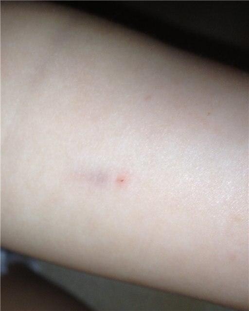 [caption id="attachment_2688" align="alignright" width="320"] Норма Манту в 1 год[/caption]