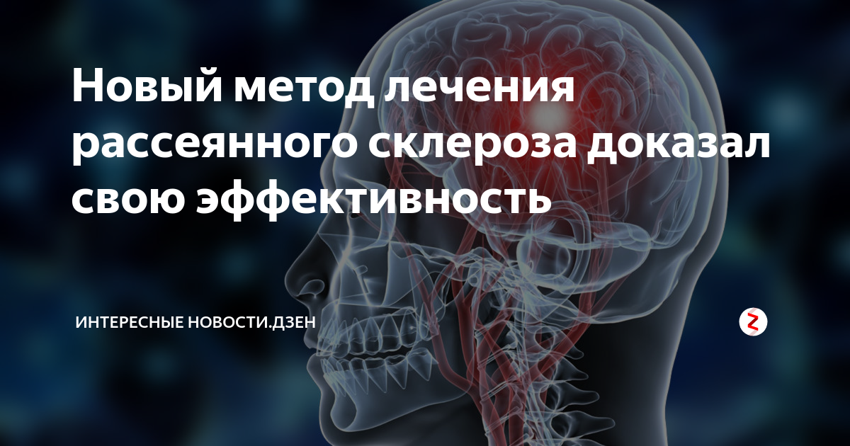 Рассеянный склероз. Лечение рассеянного склероза. Лекарство от рассеянного склероза. Терапия при рассеянном склерозе.