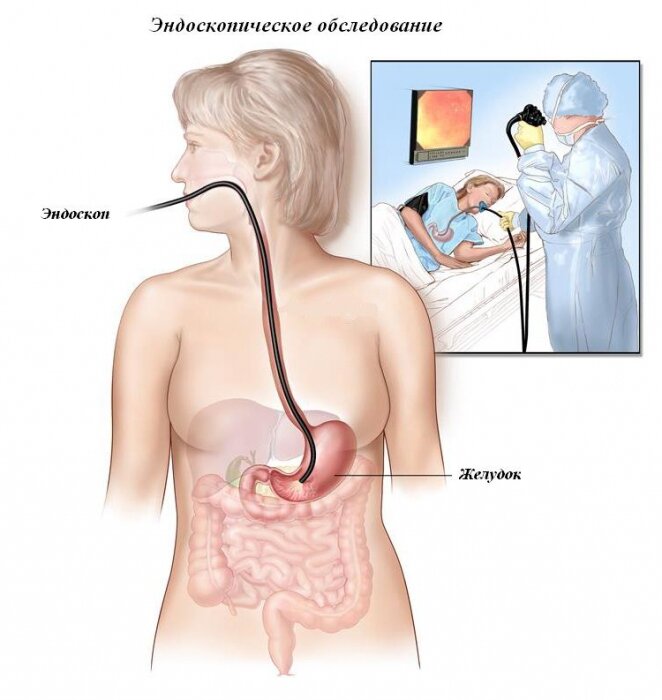 Желудочно-кишечные кровотечения, обзор [Overview of GI Bleeding]