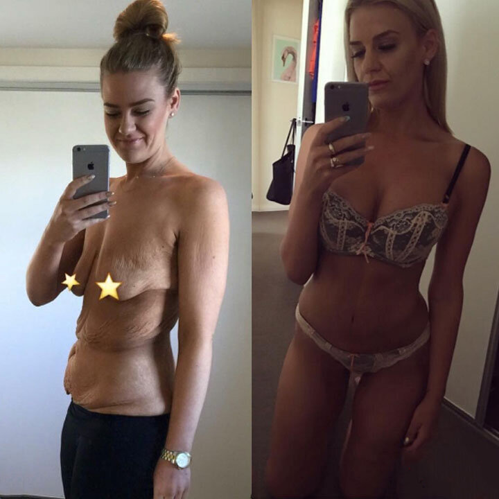 Фото "до" и "после" пластики / Dictat.net