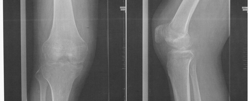 Тазобедренный анкилоз. Костный анкилоз коленного сустава. Костный анкилоз на рентгене. Анкилоз тазобедренного сустава. Фиброзно-костный анкилоз.