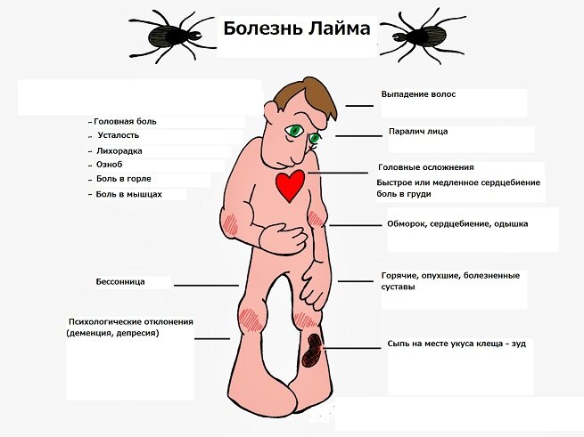 Болезнь Лайма: симптомы, последствия, лечение