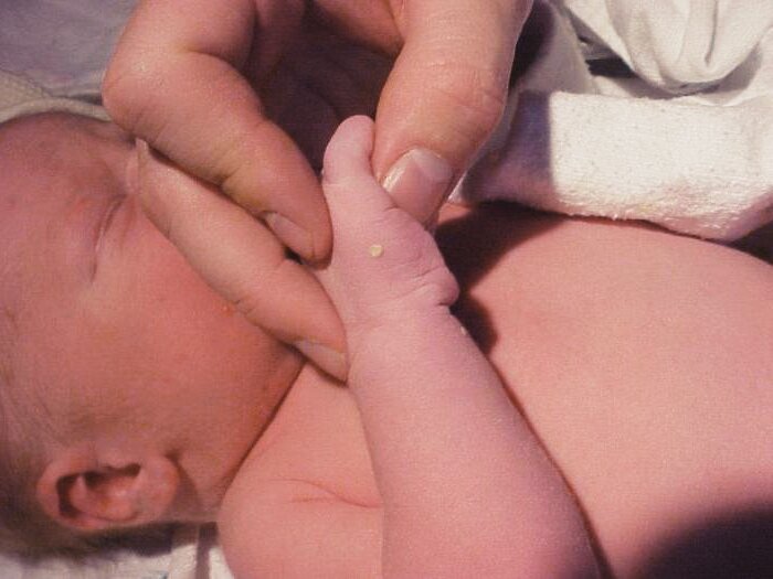 Подобные прыщички, но меньше и прозрачные. 