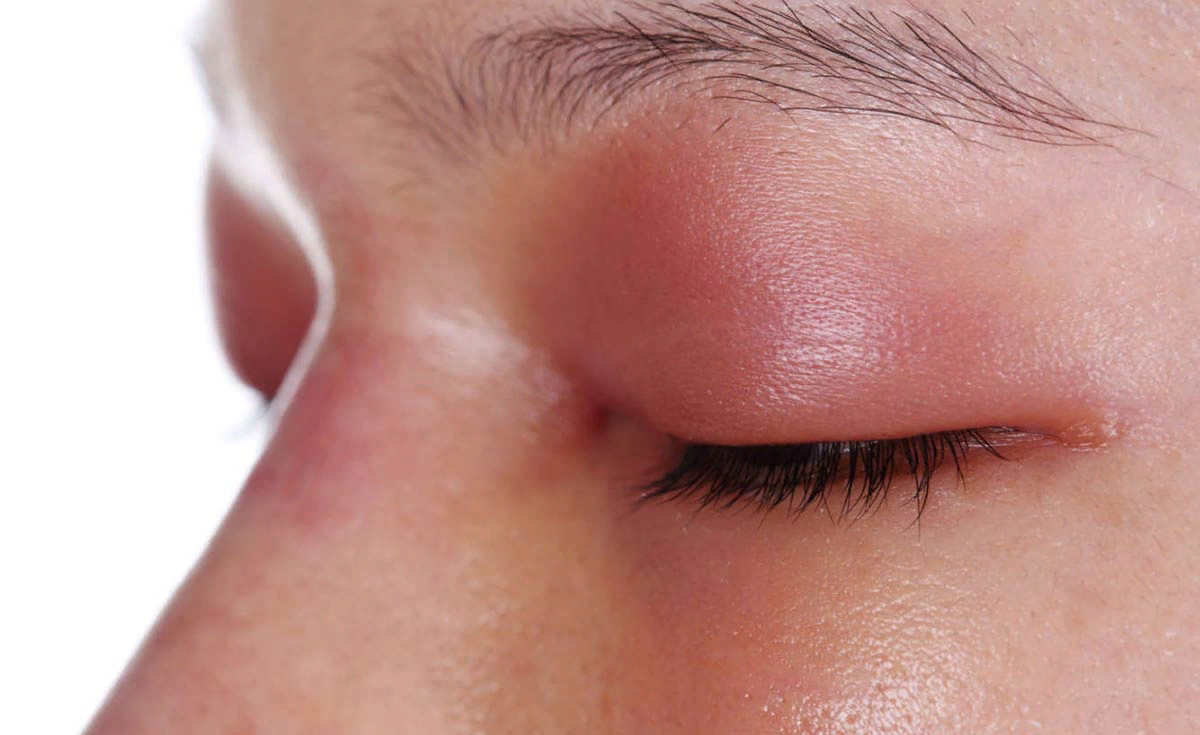 Частой причиной опухших век являются болезни глаз, такие как ячмень, аллергический конъюнктивит, а также неправильное питание, стресс, малоподвижный образ жизни. Достаточно часто веки над глазом опухают из-за употребления слишком большого количества солей, которые не успевают вывестись из организма. Диета, богатая натрием, вызывает проблемы с циркуляцией лимфы, из-за чего отек может появиться в разных частях тела, в том числе вокруг глаз. 