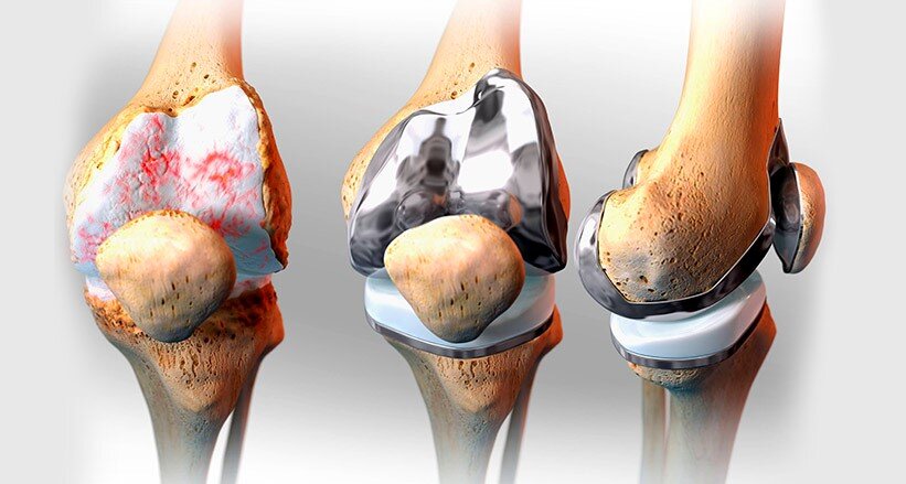 Восстановление после операции эндопротезирования коленного сустава