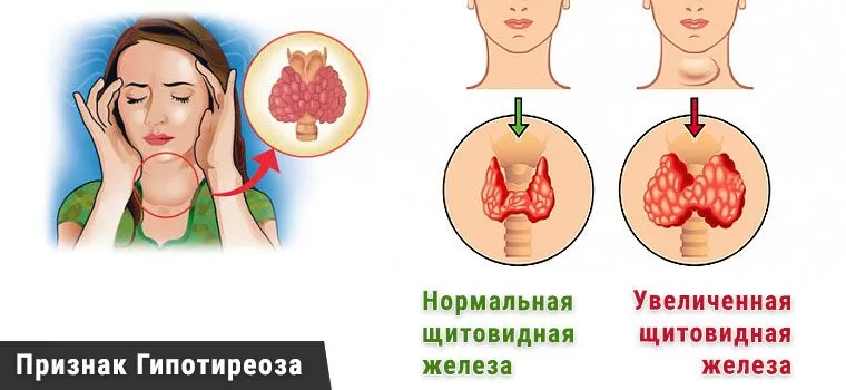 Причины и патогенез тиреоидита