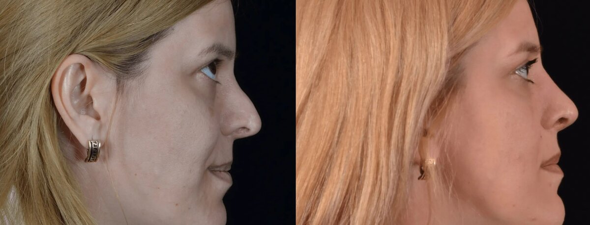 Повторная ринопластика носа. Фото до и после. Фото с сайта Д.Р. Гришкяна. Имеются противопоказания, требуется консультация специалистов