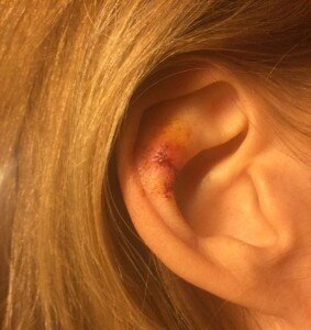 
Мое ухо после встречи с клювом 
