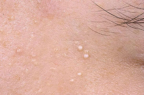 Естественно, для того, чтобы определить причину возникновения аллергического дерматита и провести необходимое, эффективное лечение нужно обязательно показаться врачу-дерматологу. Ведь только специалист может грамотно диагностировать заболевание и посоветовать необходимые методы избавления от него.
