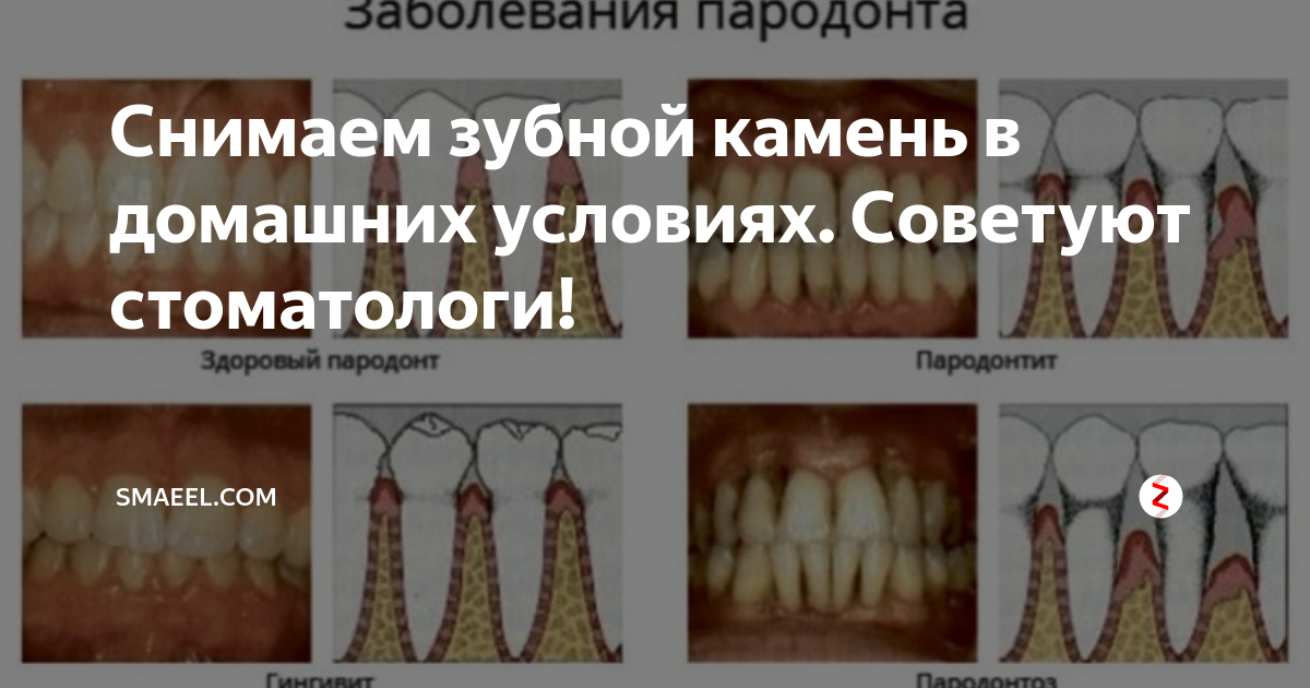 Как снять зубной камень в домашних условиях Что такое зубной камень