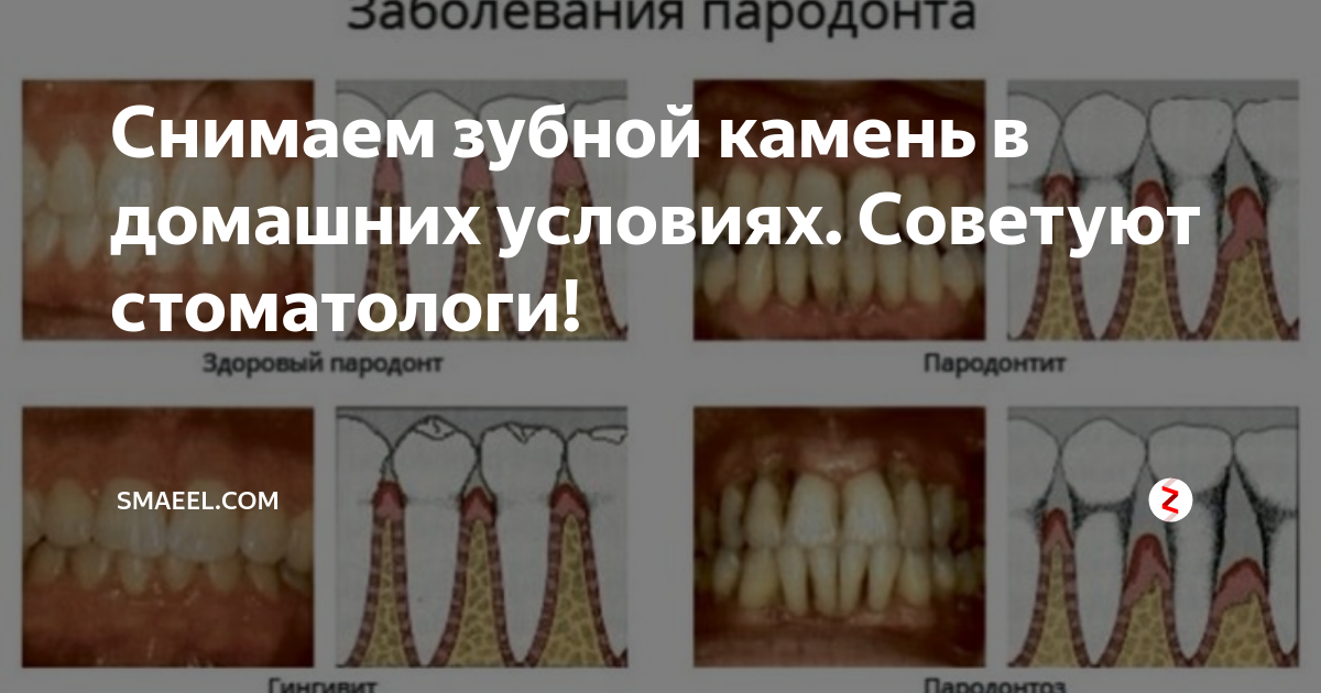 Скайсы на зубы в Москве по доступной цене Atlantis Dental