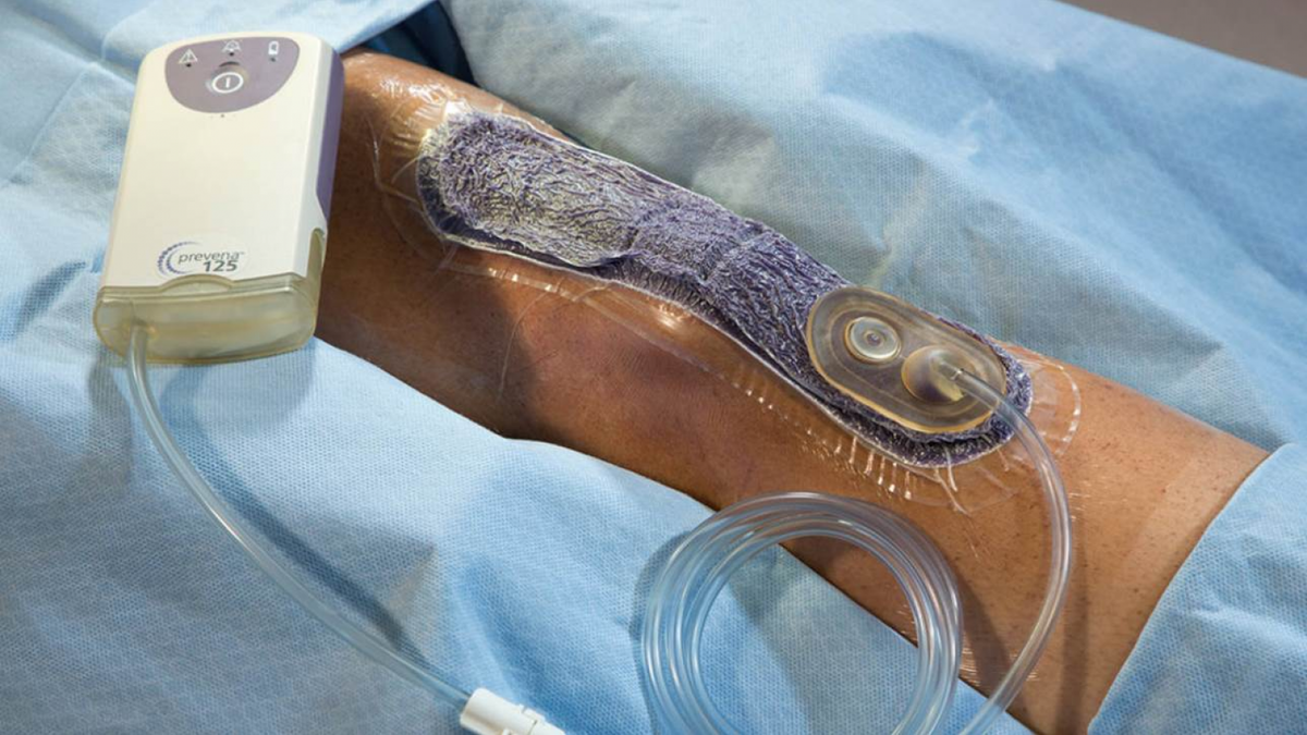 Система отрицательного давления Prevena для защиты хирургических разрезов от инфекций 