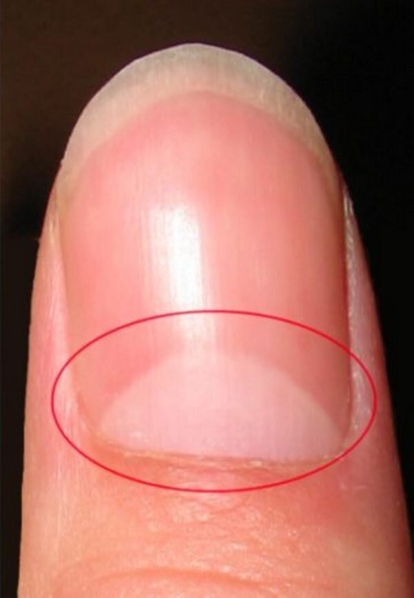 на ногтях рук лунки синие. белое пятно у основания ногтя. форма лунки ногтя. большие лунки на ногтях рук. большая лунула на ногте большого пальца.