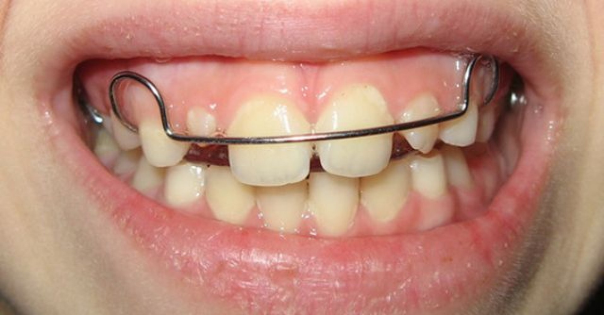 Пластина ортодонтическая фото