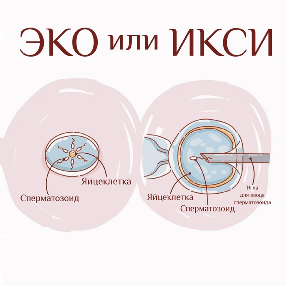 Интрацитоплазматическая инъекция спермия