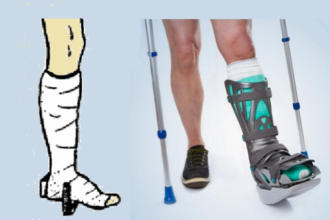  Традиционный гипс со стременем и полимерный, с ортезом заменяющим его