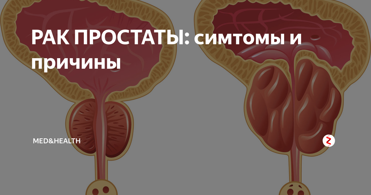 Рак простаты симптомы