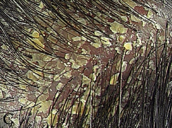 жирная себорея кожи головы