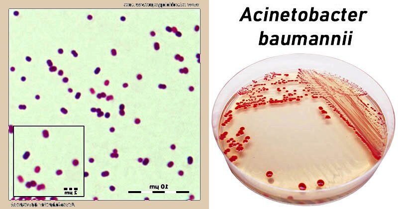Acinetobacter baumannii уриселект. Acinetobacter по граму. Acinetobacter lwoffii. Ацинетобактер. Ацинетобактер микробиология.